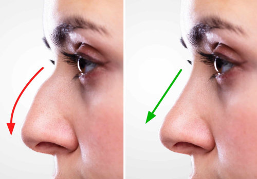 Closed Nose Job In NYC: Facial Balance Enhanced By Clinical Nutrition